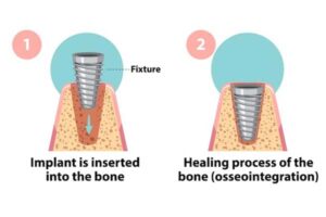 dental-implant-treatment-2