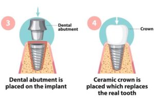 dental-implant-treatment