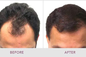 hait-transplant-1 hait-transplant-1